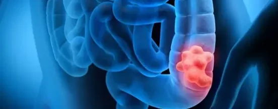 Consejos para prevenir el cáncer de colon