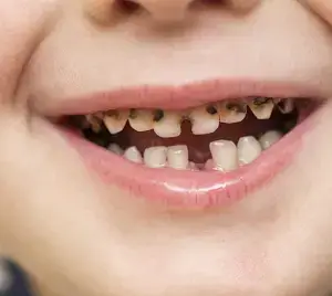 dientes niño