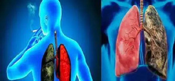 Cuáles son los síntomas del cáncer de pulmón presta atención
