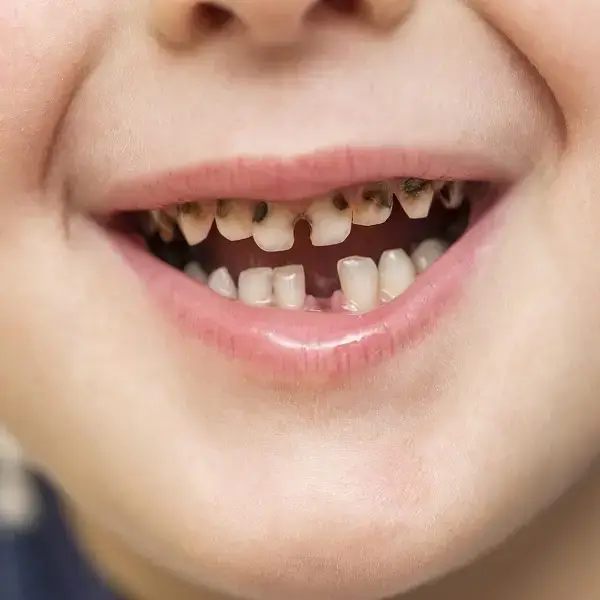 Evitar la aparición de caries en la dentadura infantil