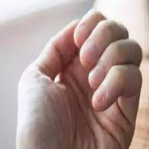 Cómo tus uñas te advierten sobre tu salud
